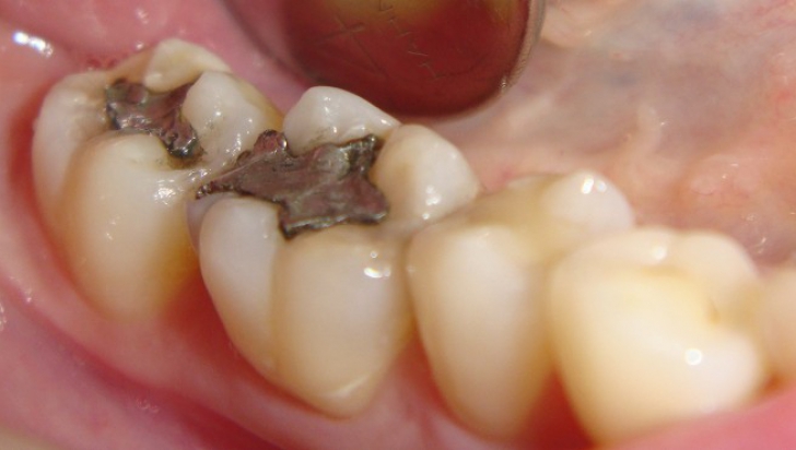 Plombele dentare vor dispărea. Tratamentul revoluţionar care REGENEREAZĂ dinţii