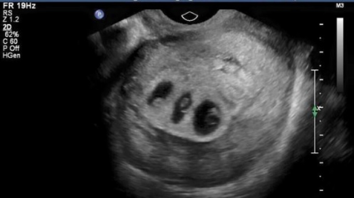 Doctorii i-au spus să aleagă care dintre cei 3 bebeluşi va trăi. Decizia ei a şocat o lume întreagă!