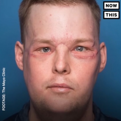 Un glonţ i-a distrus faţa. După 10 ani, bărbatul a primit un chip nou! Dovada că minunile există! / Foto: captura video