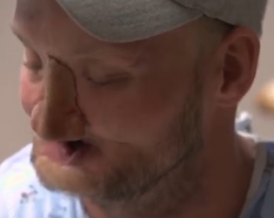 Un glonţ i-a distrus faţa. După 10 ani, bărbatul a primit un chip nou! Dovada că minunile există! / Foto: captura video