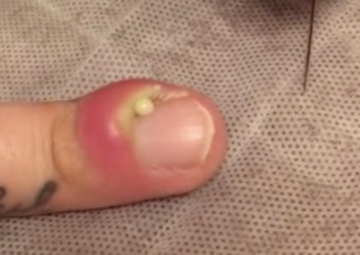 Avea o unghie infectată şi a spart buba ce s-a format pe deget. A leşinat când a văzut ce a ieşit