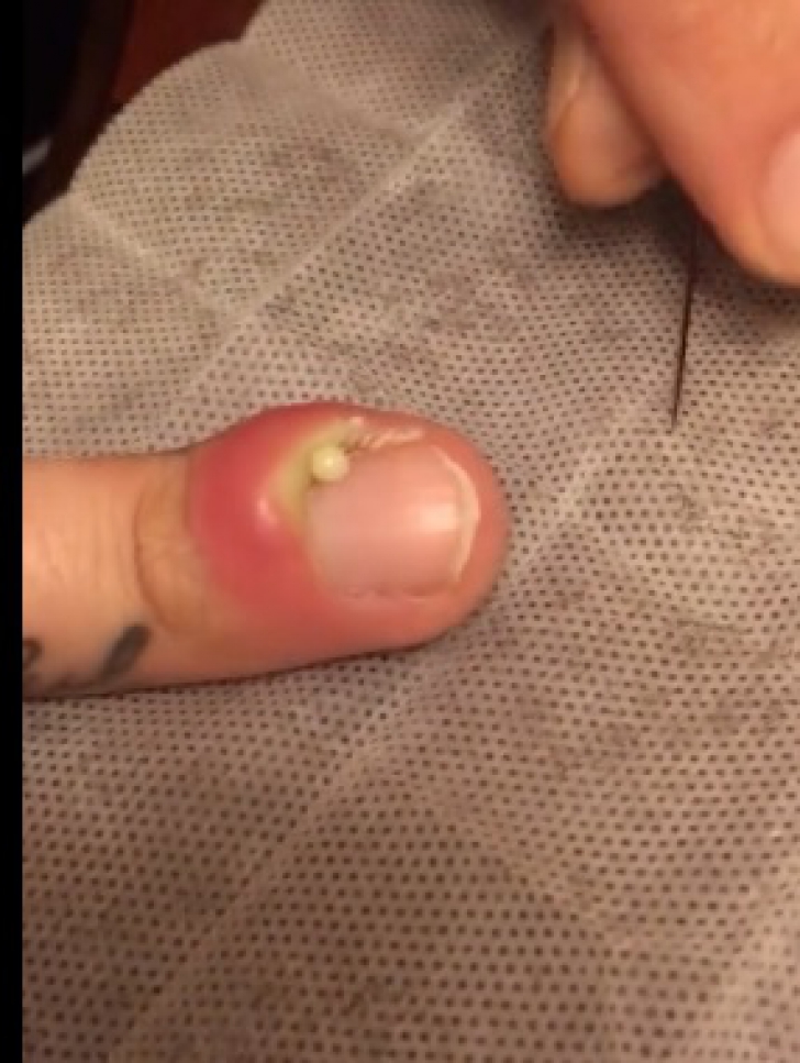 Avea o unghie infectată şi a spart buba ce s-a format pe deget. A LEŞINAT când a văzut ce a ieşit