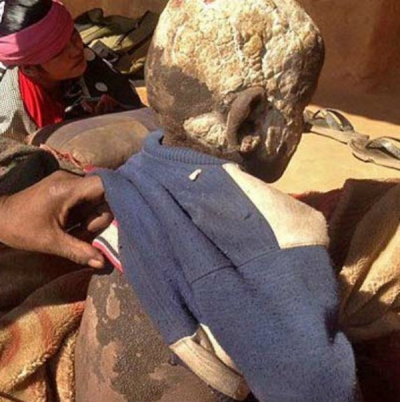 Povestea TRAGICĂ a copilului care a început să se transforme în piatră la 15 zile de la naştere
