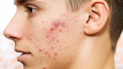 Ai faţa cicatrizată din cauza acneei? Iată patru metode simple pentru regenerarea pielii 