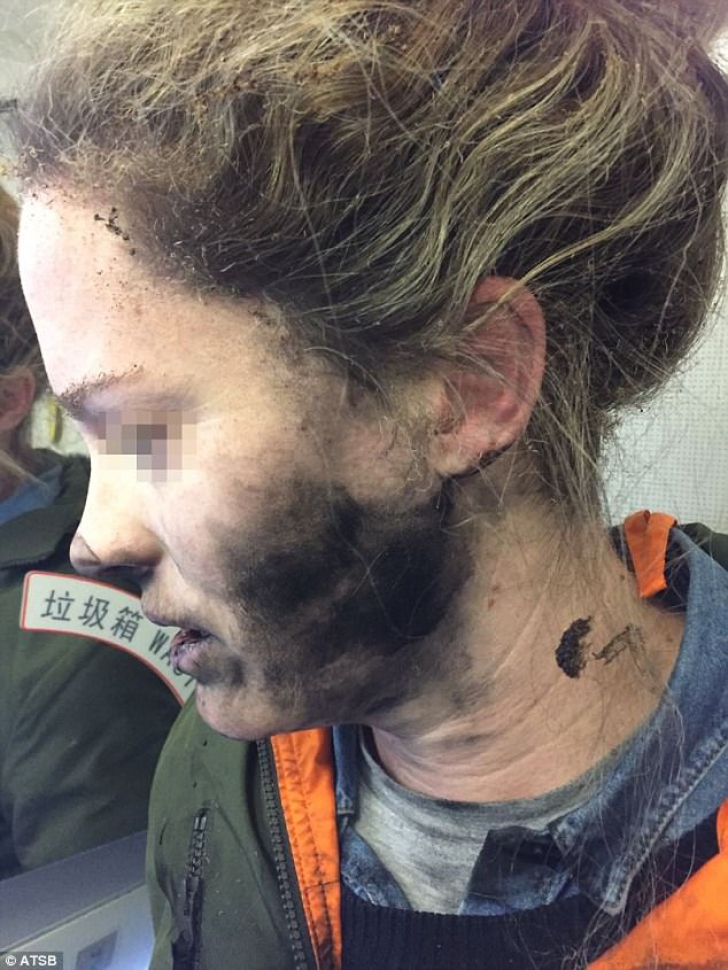Incident şocant: tânără arsă pe faţă - căştile i-au explodat în timpul unui zbor cu avionul