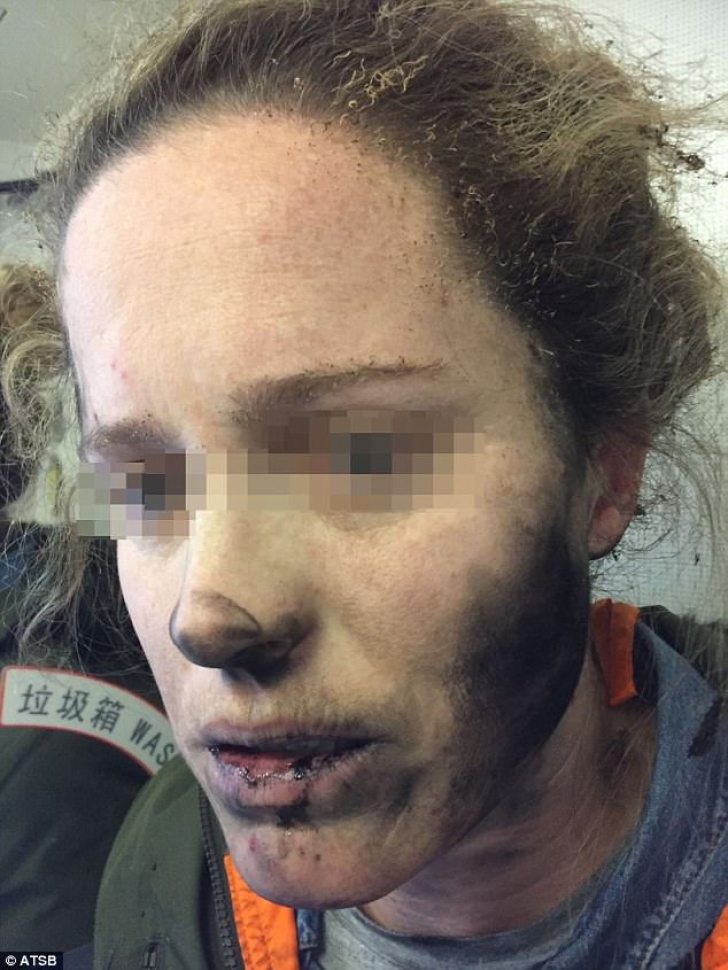 Incident şocant: tânără arsă pe faţă - căştile i-au explodat în timpul unui zbor cu avionul