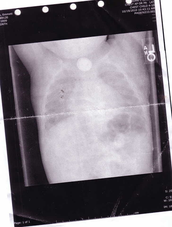 Acest micuț a suferit 65 de operații din cauza unui lucru mic, care se găsește în fiecare casă