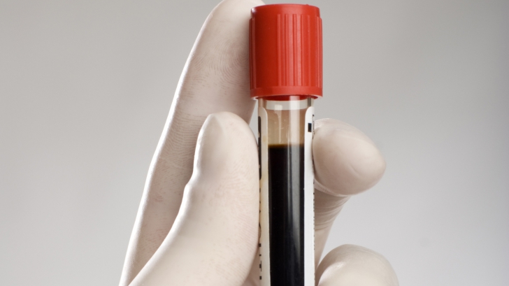 Un nou test de sânge îți poate salva viața