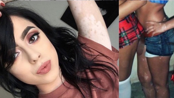 Și-a transformat trupul într-o operă de artă după ce au râs de ea pentru că suferă de vitiligo