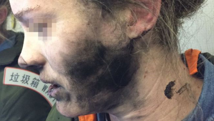 Şocant! O femeie a fost arsă pe faţă, după ce căştile telefonului au explodat