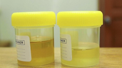 Ce înseamnă culoarea modificată a urinei şi care sunt cauzele