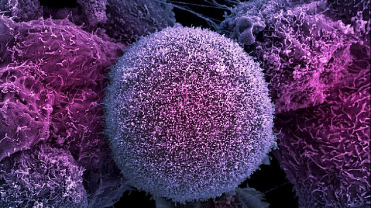 Cum poate fi prevenit cancerul colorectal