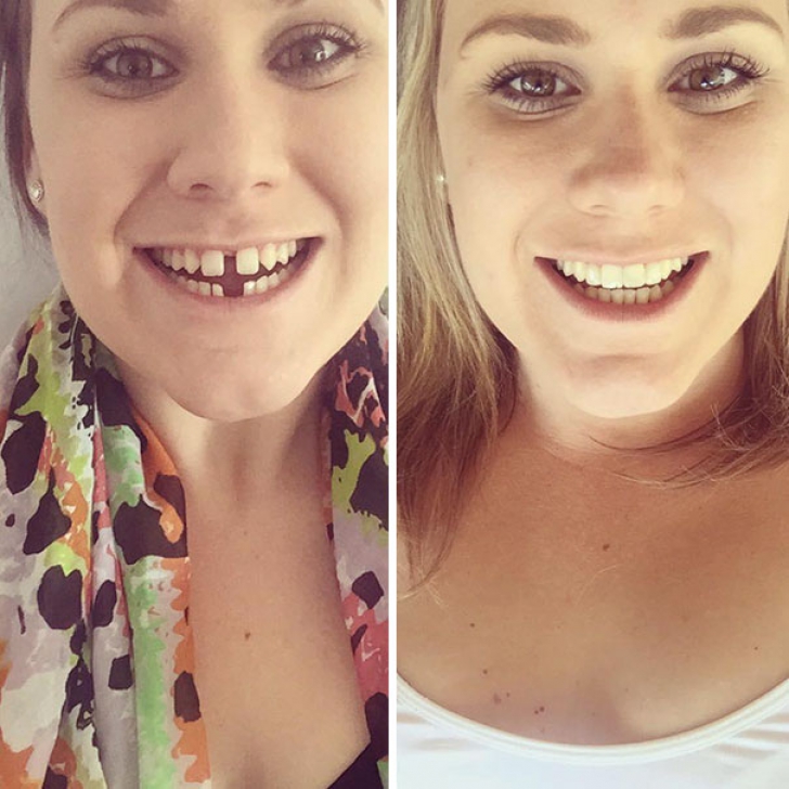 Top cinci transformări incredibile ale oamenilor care au purtat aparat dentar! Rămâi uimit