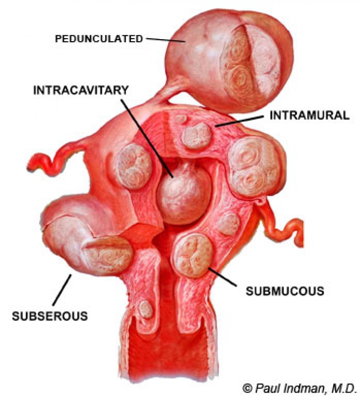Fibromul uterin. Simptomele care ar trebui să alarmeze femeile. Durerea de spate, una dintre ele 