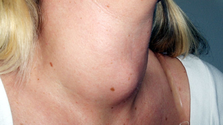 Când şi cât ne îngrăşăm din cauza tiroidei. Este glanda vinovată de kilogramele în plus?