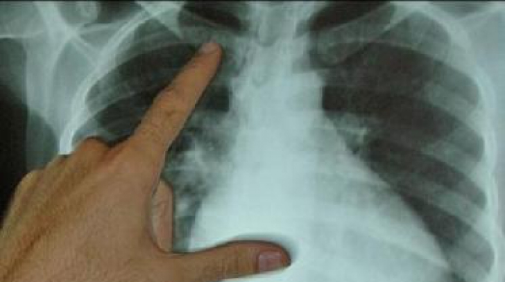 Pericol de epidemie TBC într-un oraş din România