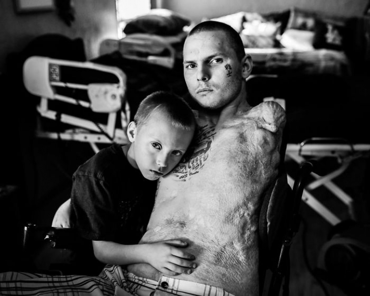Urmele războiului pe trupurile soldaţilor! Fotografii emoţionante cu oameni mutilaţi pe viaţă
