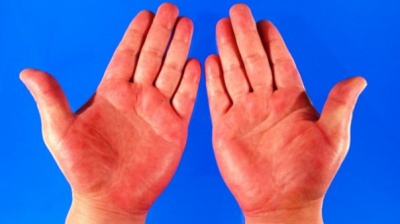 Palmele roșii, semn de boală