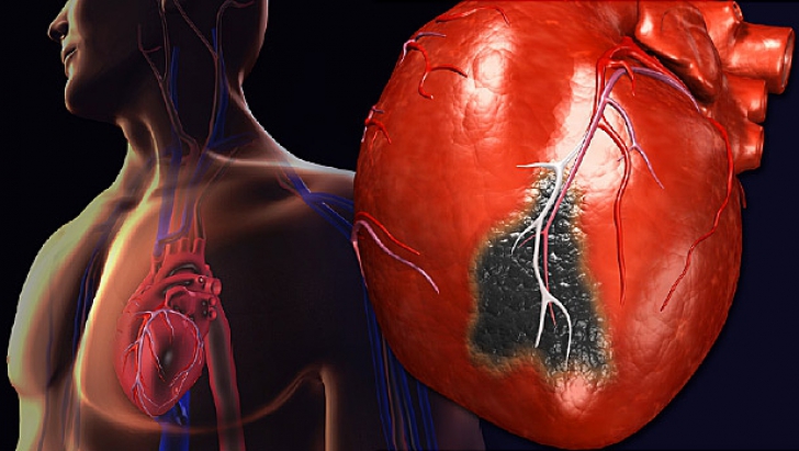 Simptomele acestea îţi spun că vei avea un atac de cord în următoarele 30 de zile