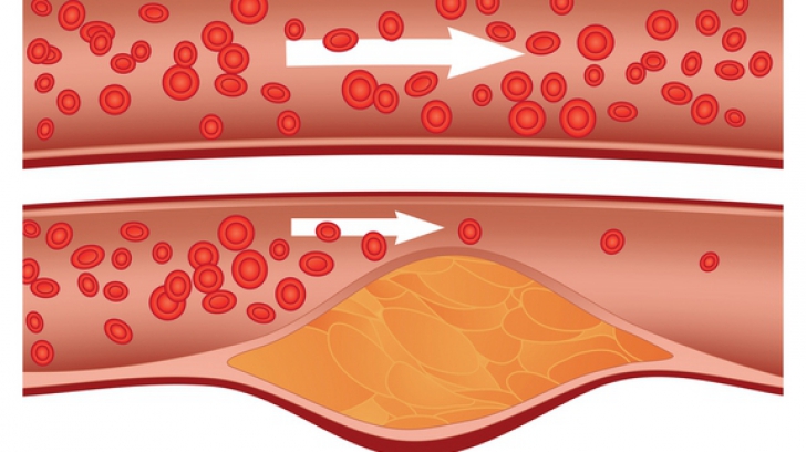 Cum puteți să preveniți înfundarea vaselor de sânge