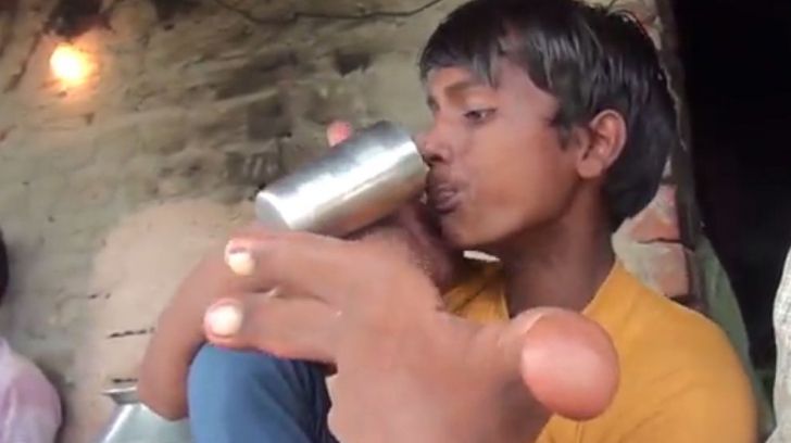 Drama unui copil din India: Suferă de o boală extrem de rară și nimeni nu vrea să se aproprie de el