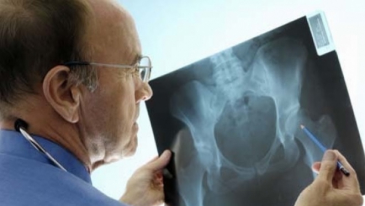 Cel mai bun tratament pentru osteoporoză