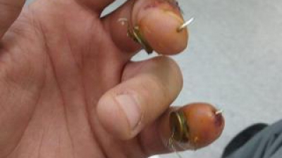 "Chirurgul cu mâini de aur" acuzat că ar fi operat un deget sănătos