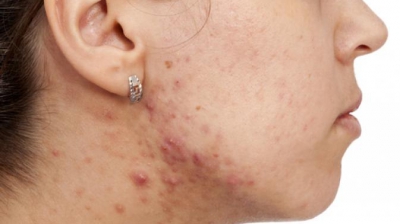 Cum să scapi definitiv de acnee și de cicatricele provocate de această afecțiune