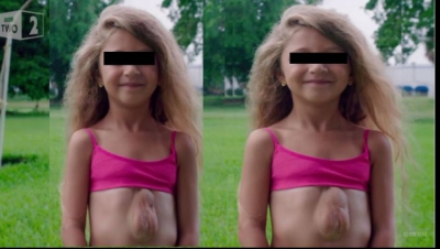 Îi bate inima în afara corpului! Cum a reușit să supraviețuiască