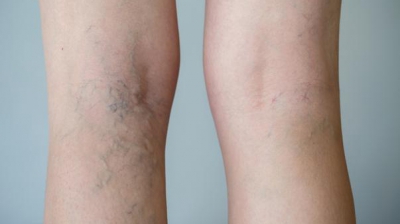 inflamarea venelor la picioare ce este varicos pentru femeie