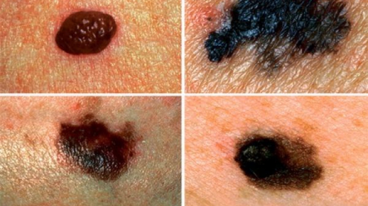 Cum ne dăm seama că o aluniță s-a transformat în cancer de piele
