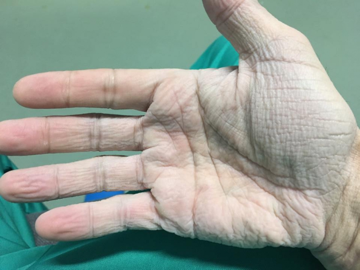VIRAL. Cum arată mâna unui cardiolog, după 12 ore de operaţie, la 30 de grade