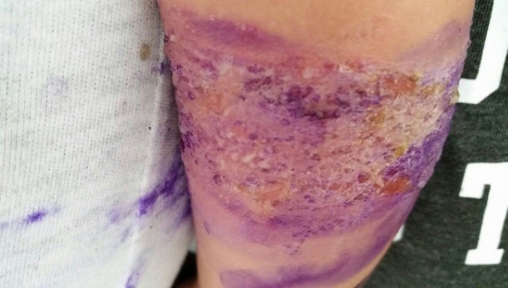 Imagini revoltătoare la Spitalul din Slatina! Copil infectat de un leucoplast