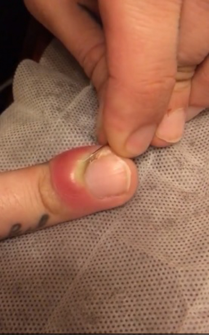 Avea o unghie infectată şi a spart buba ce s-a format pe deget. A leşinat când a văzut ce a ieşit