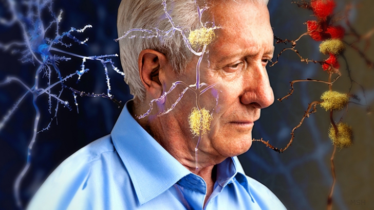 Ipoteză șocantă: boala Alzheimer s-ar putea transmite prin transfuzii