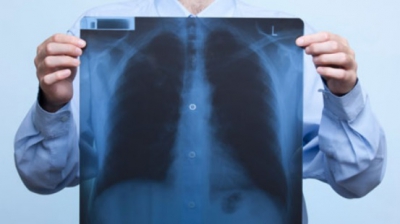 Cât de des se pot face radiografiile la plămâni?