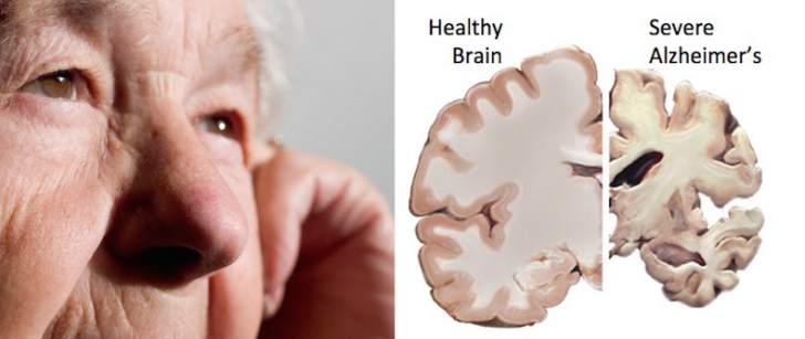 Descoperire de senzație în studiul bolii Alzheimer