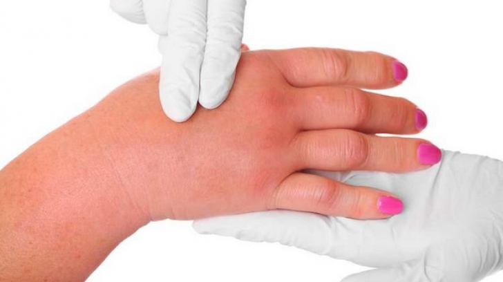 recenzii de edem comun durere în articulațiile membrelor mâinilor și picioarelor