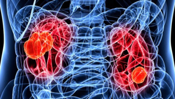 5 semne subtile de cancer la rinichi