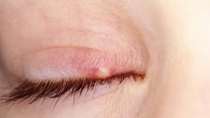 infectie la pleoapa ochiului tulburări neurologice-vizuale