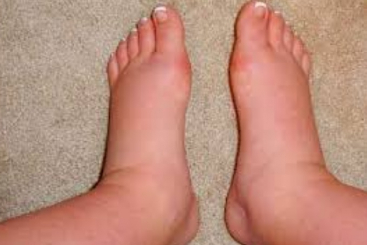 Blog Faunus Plant - 3 Remedii pentru combaterea picioarelor umflate