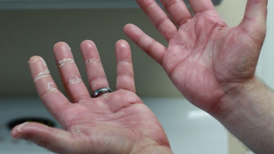 Simptomele cancerului apar prima dată pe m&acirc;nă. Cum arată