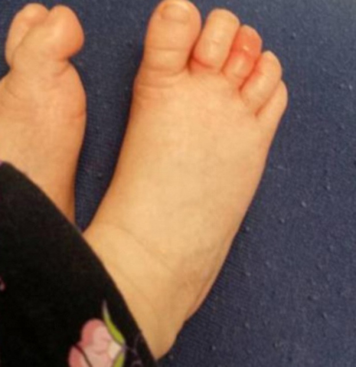 Degetul mare de la picior umflat și roșu = gută?
