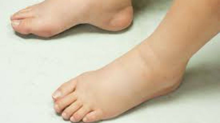 tratamentul de pe pereții varicoși pe picioarele picioarelor varicosecia tratează peroxidul