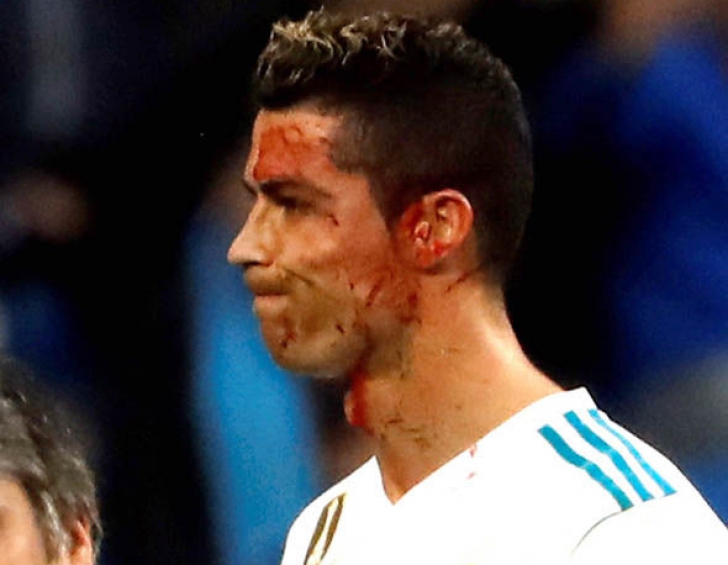 Ce i s-a întâmplat lui Ronaldo e absolut îngrozitor! Imaginile fac înconjurul lumii (VIDEO)