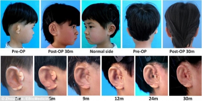 Tehnică revoluţionară în China: cinci copii au urechi noi, naturale, printate 3D (FOTO)