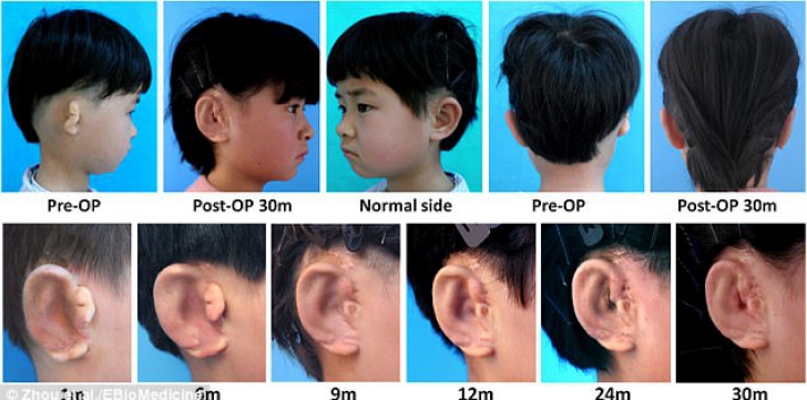 Tehnică revoluţionară în China: cinci copii au urechi noi, naturale, printate 3D (FOTO)