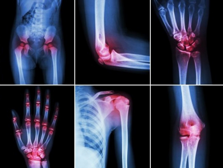 artrita și tratamentul cu artroză care este diferența)