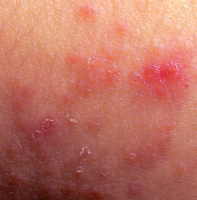 Dermatita atopică. Cauzele nebănuite prin care pielea poate arăta aşa 