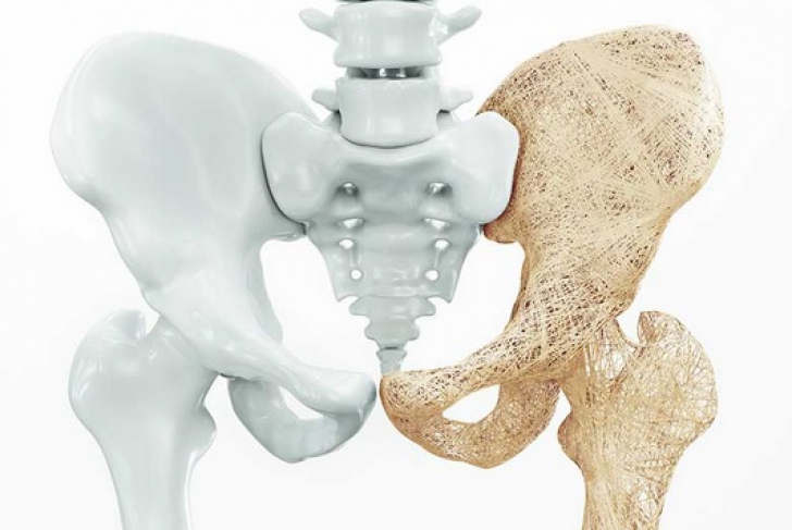 10 semne că vei face osteoporoză